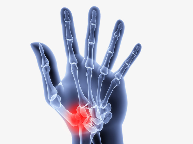 Arthrite articulaire basale du pouce