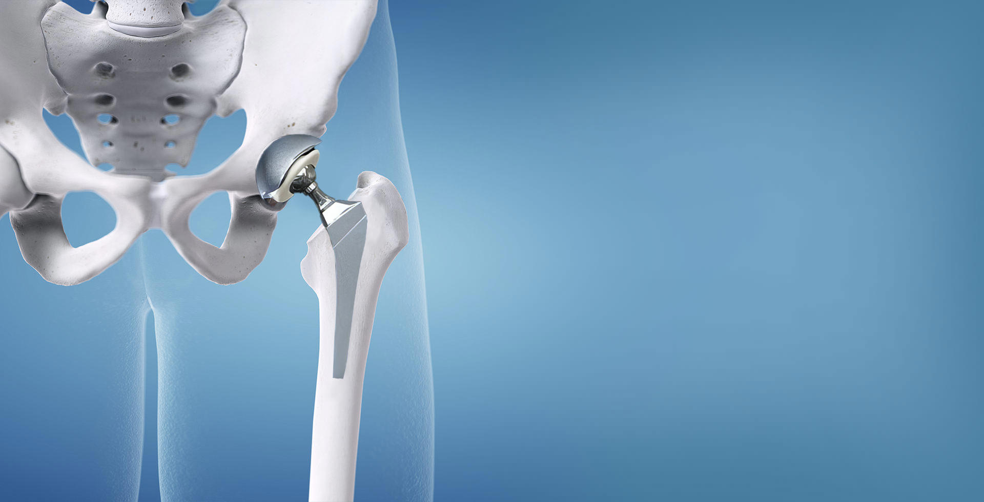 Combien De Temps Dure Une Prothèse De Hanche Prothèse totale de la hanche à Montréal | Chirurgien orthopédique