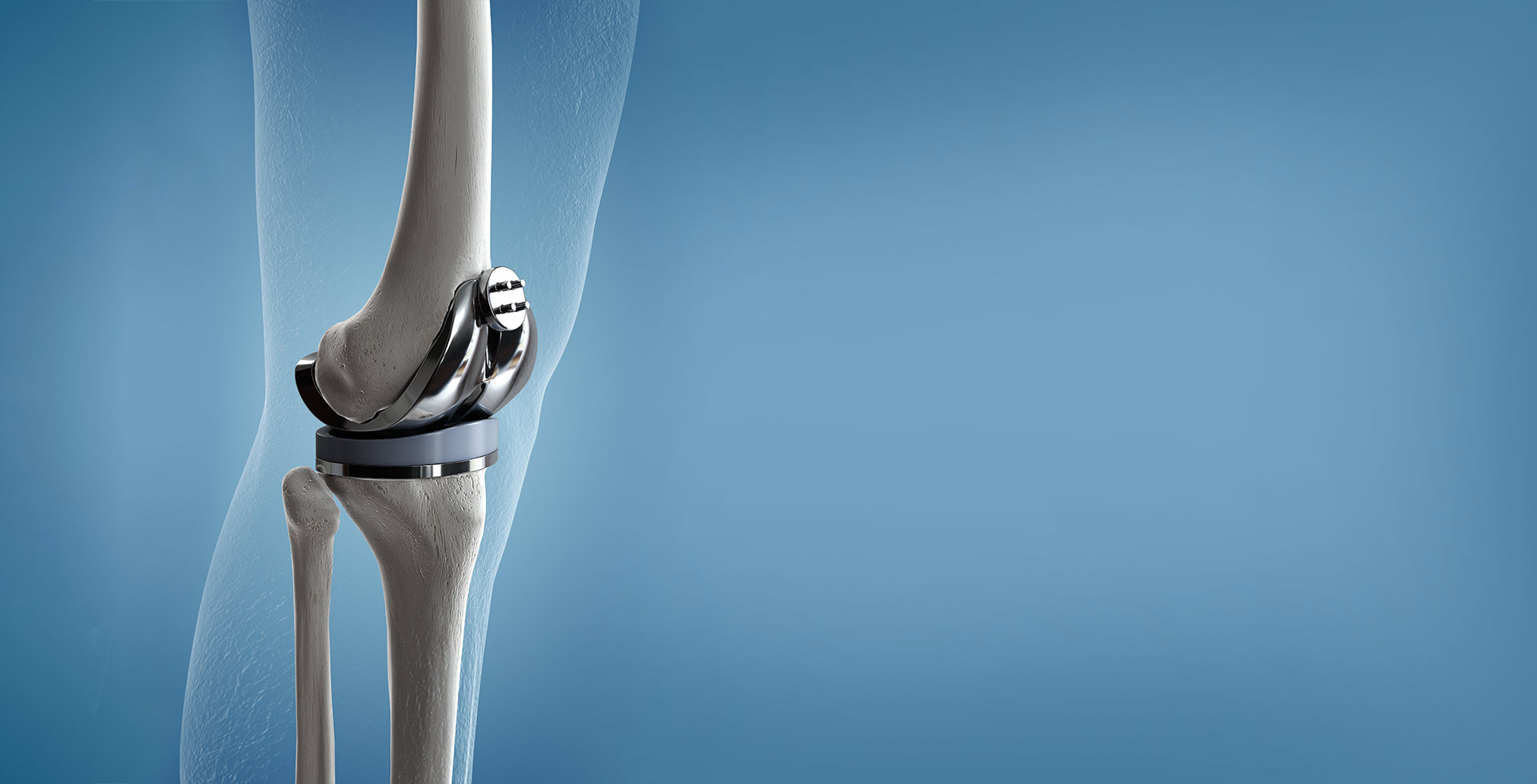 Hanche Comment Dormir Avec Une Prothese De Genou Prothèse de genou à Montréal | Chirurgien orthopédique